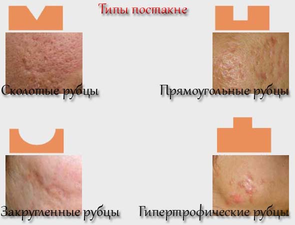Как убрать с лица постакне в домашних условиях